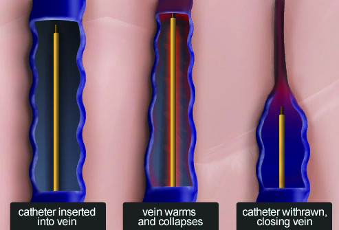 Illustration of catheter in vein for treatment