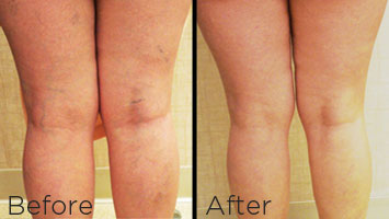 Before and after treatment of spider veins in legs