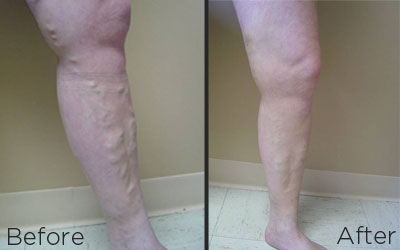 Before and after treatment of varicose veins in legs